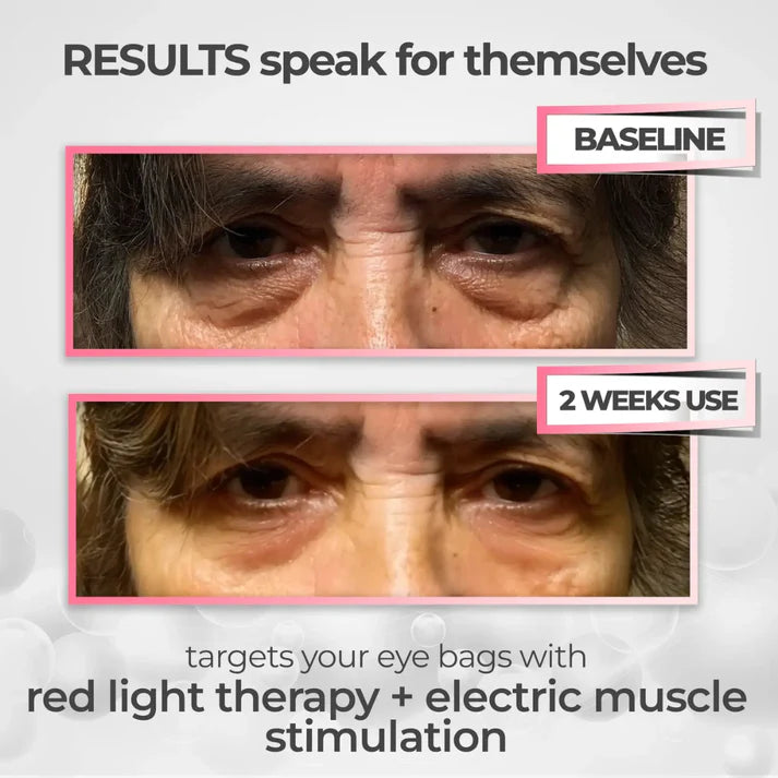 Solava  2-in-1 Red Light Therapy + EMS To Erase Eye Bags