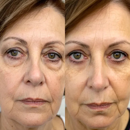 Solava  2-in-1 Red Light Therapy + EMS To Erase Eye Bags