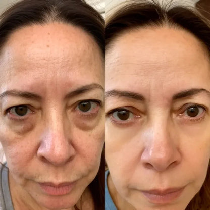Solava  2-in-1 Red Light Therapy + EMS To Erase Eye Bags